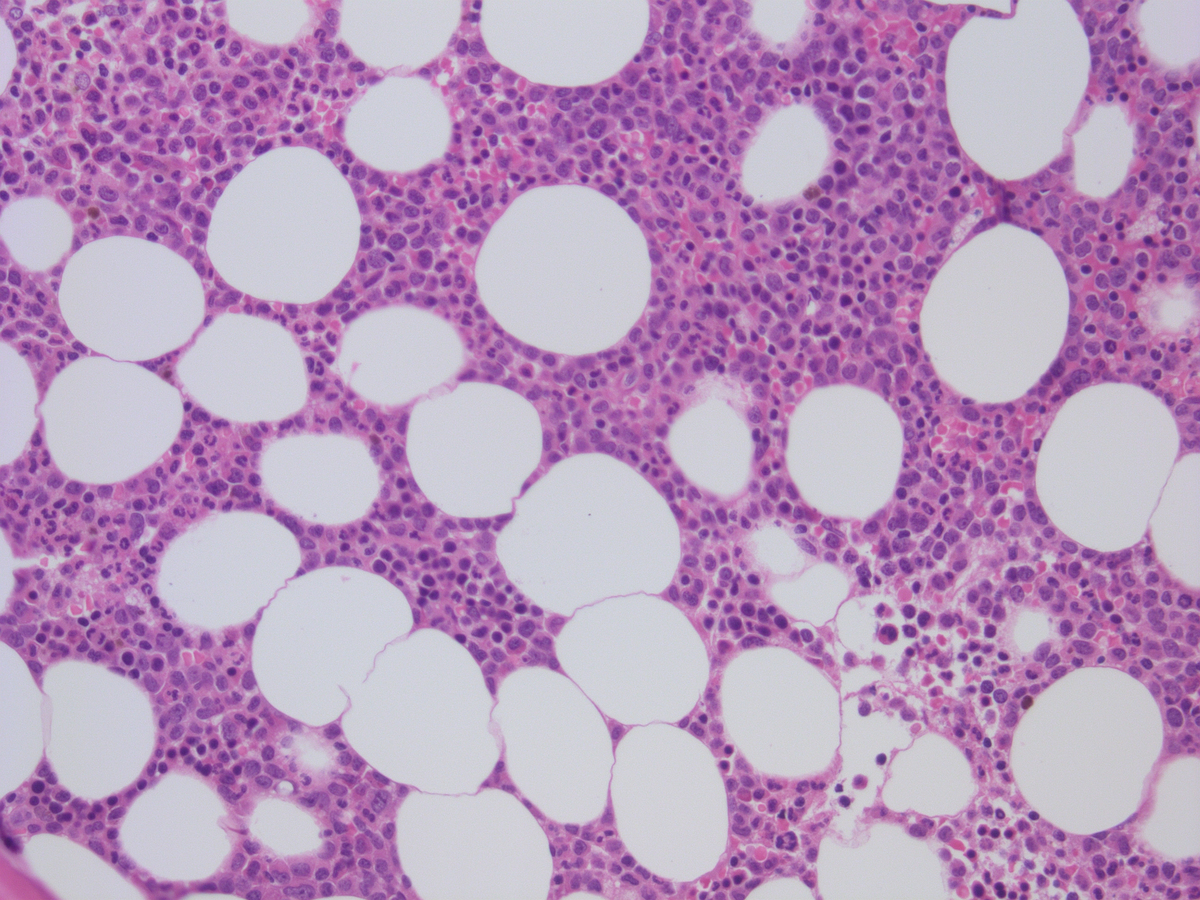 Bone marrow biopsy relapse 1.2013